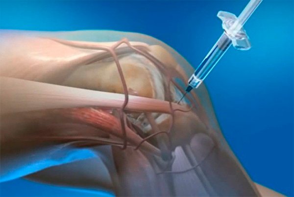 Ортопедическая блокада под контролем УЗИ в Варшаве — Lama Clinic (Mokotów)