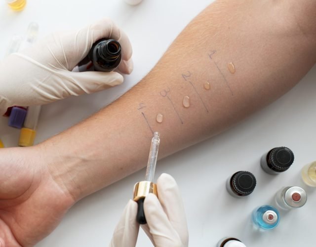 skin-allergy-reaction-test-person-s-arm